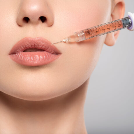 Close-up of a woman’s lips as she receives a hyaluronic acid filler treatment using a syringe for lip volume and augmentation, on a neutral background.