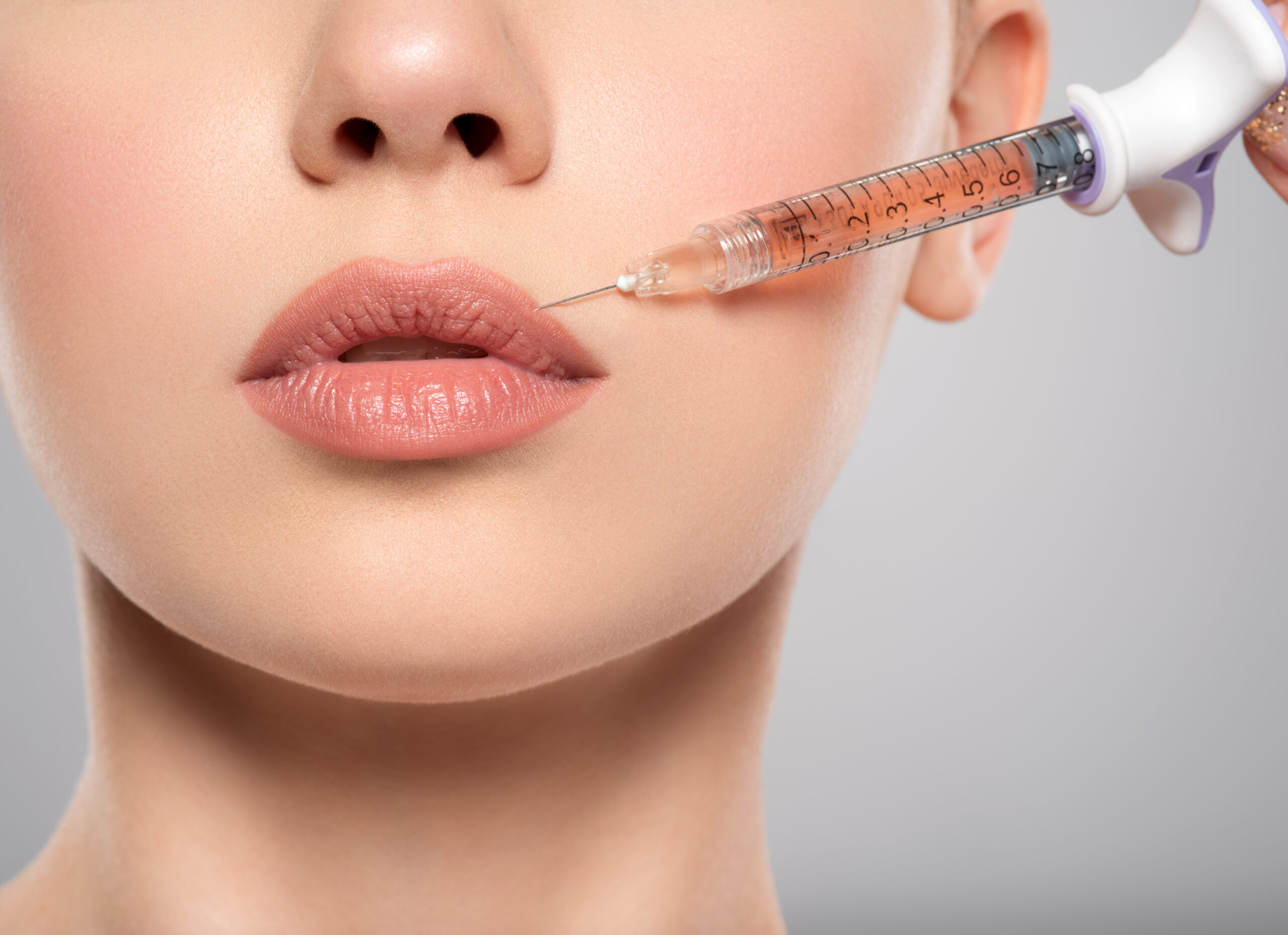 Close-up of a woman’s lips as she receives a hyaluronic acid filler treatment using a syringe for lip volume and augmentation, on a neutral background.
